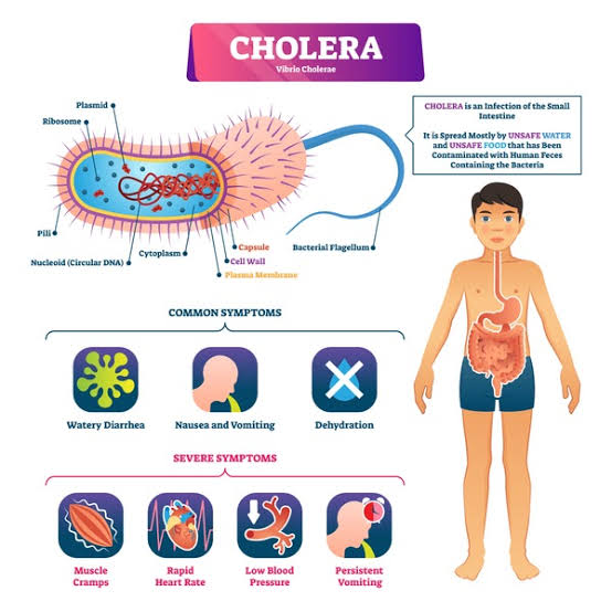 Photo of symptoms of cholera 